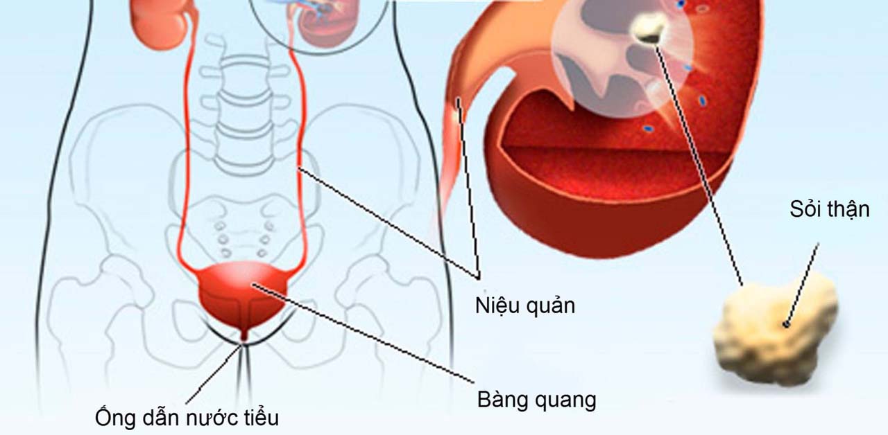 Mổ mở lấy sỏi niệu quản có nên không?