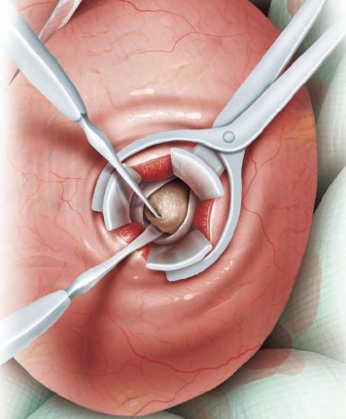 Mổ mở lấy sỏi niệu quản có nên không?