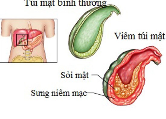 Mổ nội soi sỏi mật bao nhiêu tiền?