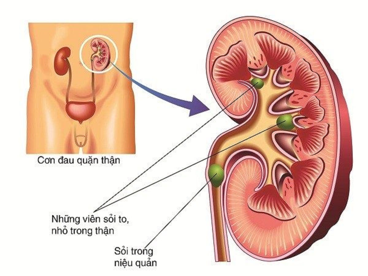 Mổ nội soi sỏi tiết niệu và 5 thông tin cần biết để điều trị hiệu quả