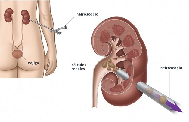 Mổ nội soi sỏi tiết niệu và 5 thông tin cần biết để điều trị hiệu quả