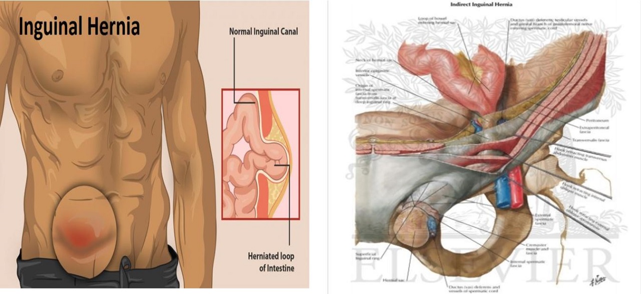 Mổ nội soi thoát vị bẹn và những thông tin cần biết