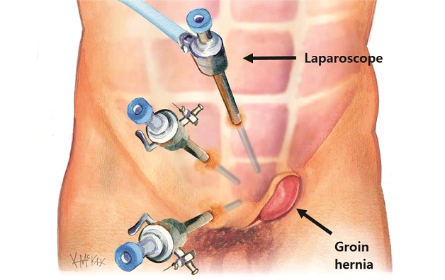 Mổ nội soi thoát vị bẹn và những thông tin cần biết