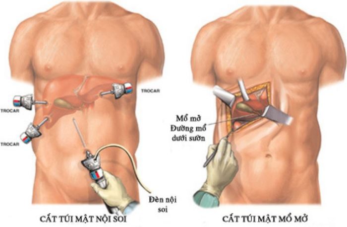 Mổ nội soi viêm túi mật và những điều cần biết