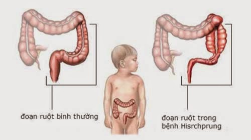 Mổ phình đại tràng bẩm sinh tử vong do không được điều trị