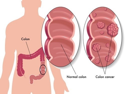 Mổ polyp dạ dày mang lại hiệu quả cao