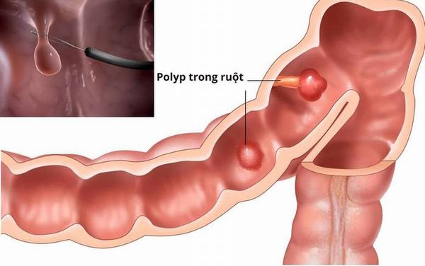 Mổ polyp đại tràng nên ăn gì và không nên ăn gì?