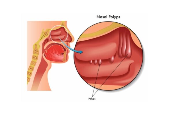 Mổ polyp mũi bao nhiêu tiền, có hiệu quả không?