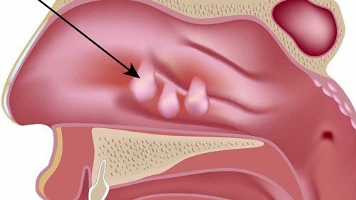 Mổ polyp mũi có đau không?chữa trị kịp thời