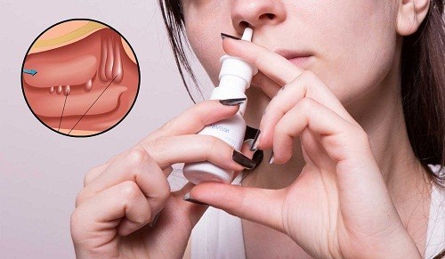 Mổ polyp mũi có đau không?chữa trị kịp thời