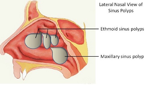 Mổ polyp mũi người bệnh nên tới các bệnh viện