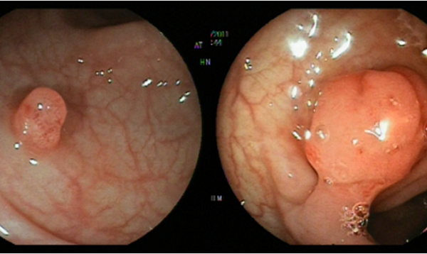 Mổ polyp trực tràng có nguy hiểm không?