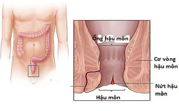 Mổ rò hậu môn – Phương pháp điều trị hiệu quả