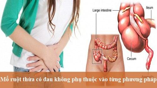 Mổ ruột thừa có đau không? Làm gì để hồi phục nhanh?