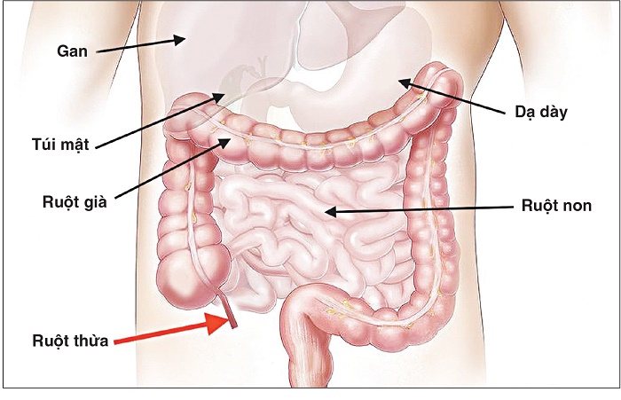 Mổ ruột thừa có mang thai được không?