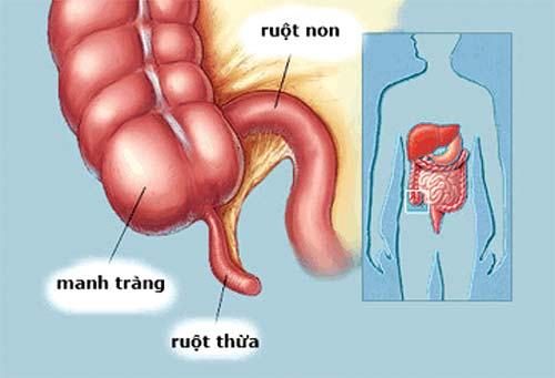 Mổ ruột thừa được hưởng bảo hiểm không? Mức hưởng BHYT