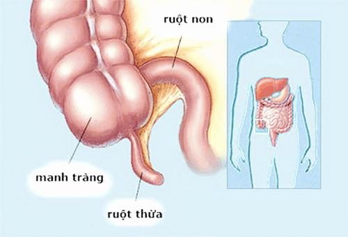 Mổ ruột thừa nội soi không đau – Phẫu thuật cắt ruột thừa