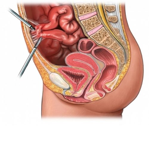 Mổ ruột thừa xong bị dính ruột là sao?