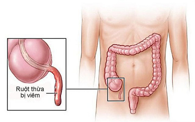 Mổ ruột thừa xong bị sốt phải làm sao để khỏi?