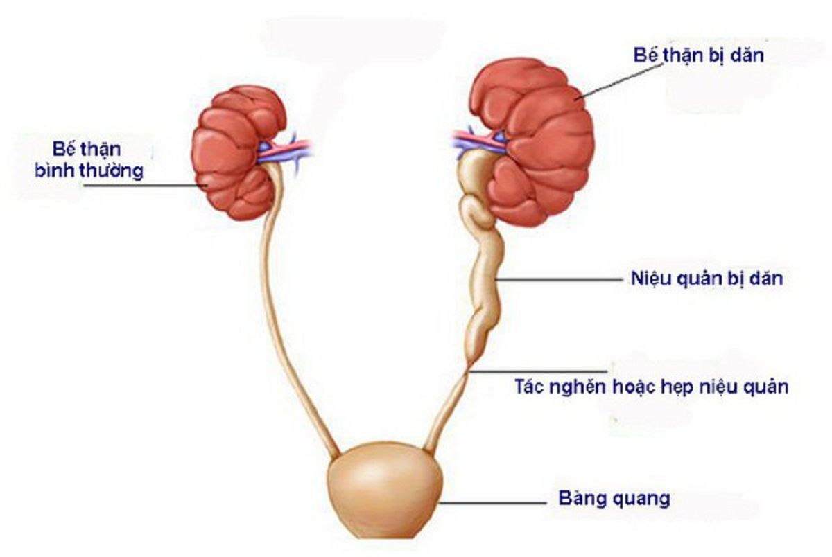 Mổ tạo hình niệu quản và những điều người bệnh cần biết