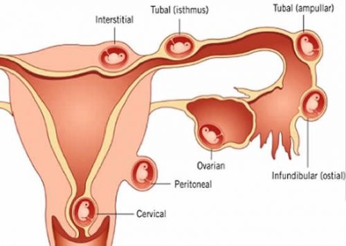 Mổ thai ngoài tử cung bao lâu quan hệ được?