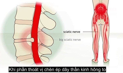 Mổ thoát vị đĩa đệm như thế nào cho nhanh khỏi?