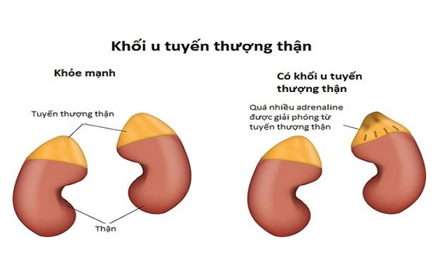 Mổ u tuyến thượng thận: Những thông tin cần biết