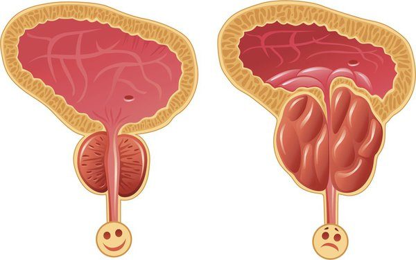 Mổ u xơ tiền liệt tuyến thế nào?