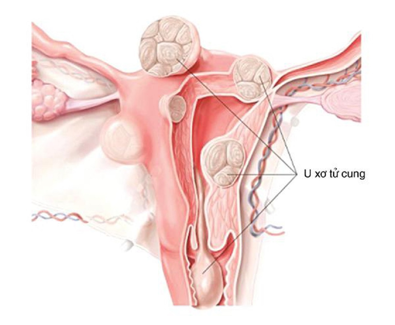 Mổ u xơ tử cung có nguy hiểm không?