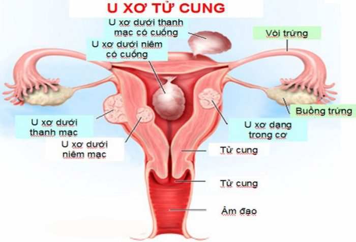 Mổ u xơ tử cung nằm viện bao lâu?