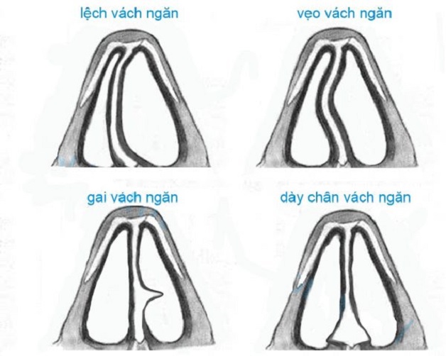 Mổ vẹo vách ngăn mũi và những vấn đề không thể chủ quan