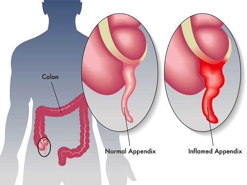 Mổ viêm ruột thừa có nguy hiểm không?