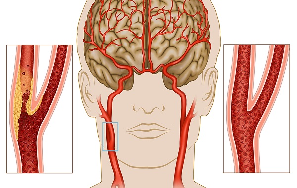 Mối liên hệ giữa đột quỵ và tình trạng giảm tuổi thọ