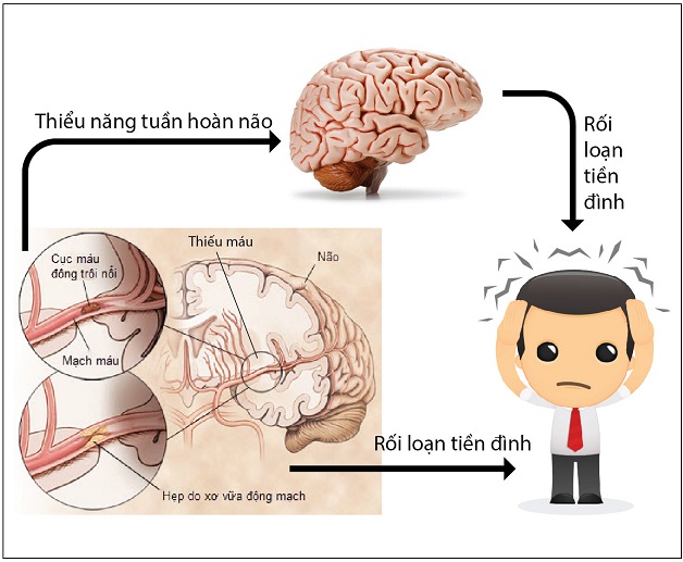 Mối liên hệ giữa thiếu máu não rối loạn tiền đình