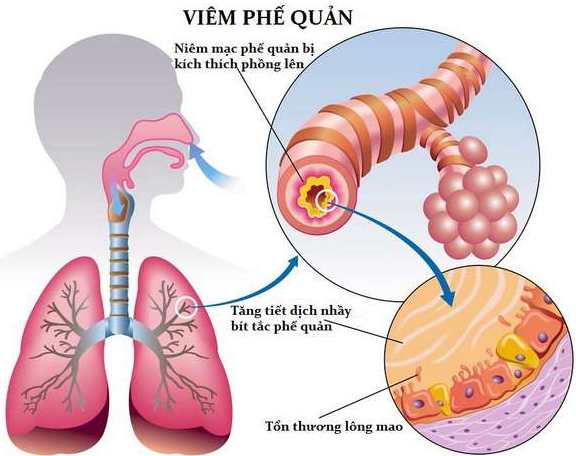 Mối liên hệ giữa viêm phổi và viêm phế quản