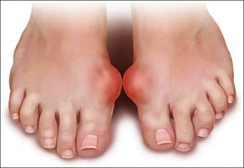 Món ăn từ cá rô đồng chữa bệnh Gout hiệu quả