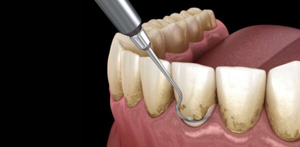 Một số cách để đánh bật cao răng ngay tại nhà