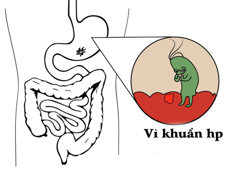 Một số triệu chứng bạn đã nhiễm vi khuẩn HP