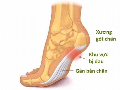 Một số vị trí viêm cơ chân thường gặp