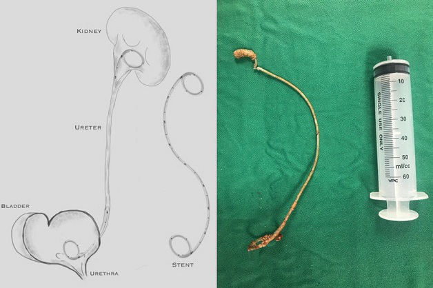 Mục đích đặt sonde JJ niệu quản là gì?