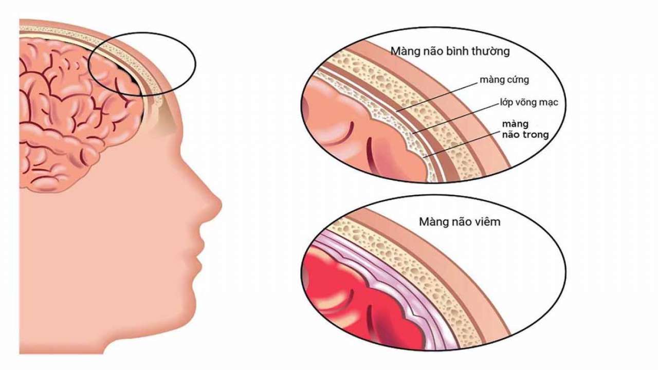 Mức độ cần thiết của mũi tiêm viêm màng não mủ cho trẻ