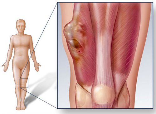 Mức độ nguy hiểm của bệnh ung thư xương