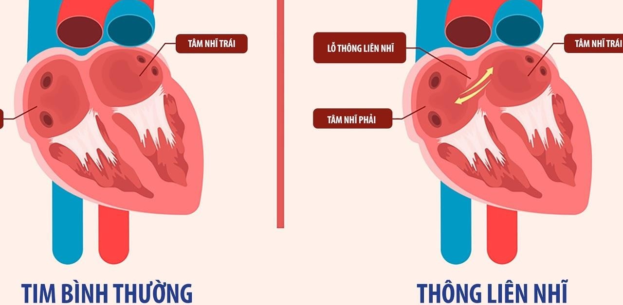 Mức độ nguy hiểm và cách điều trị thông liên nhĩ