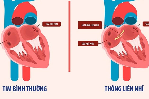 Mức độ nguy hiểm và cách điều trị thông liên nhĩ