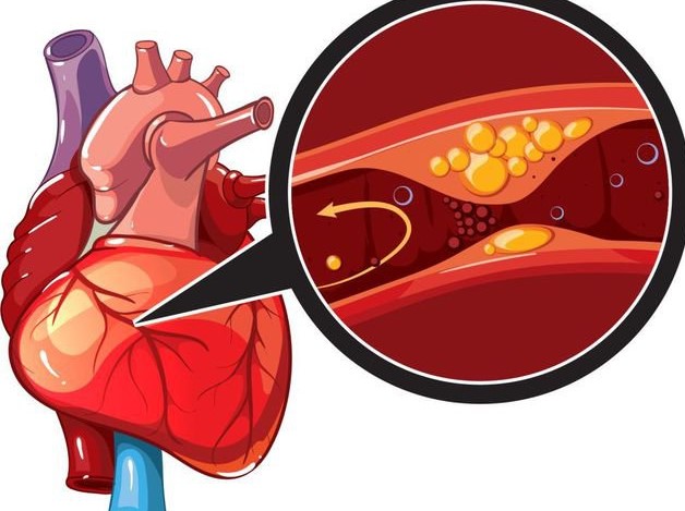 Mức độ nguy hiểm và chuẩn đoán bệnh tim do thiếu máu cục bộ