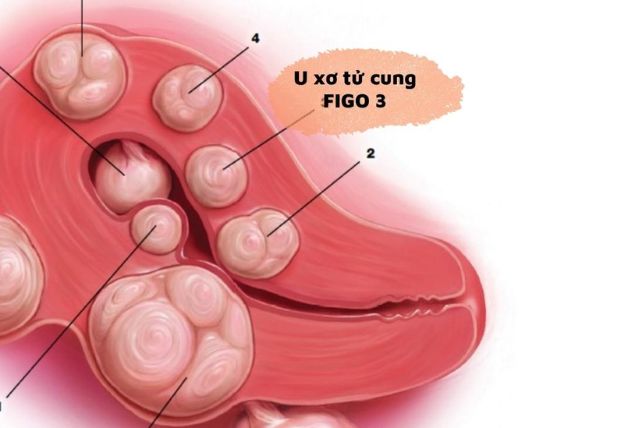 Mức nguy hiểm của 8 loại u xơ tử cung theo FIGO