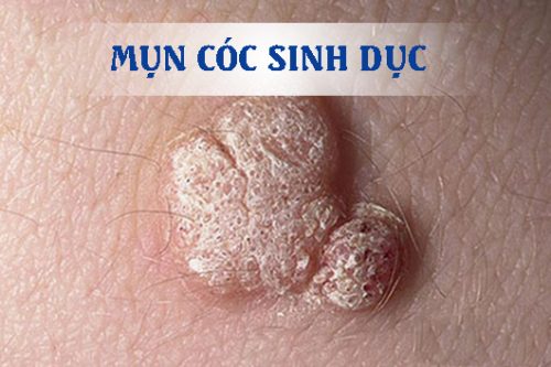 Mụn cóc sinh dục và những điều cần biết