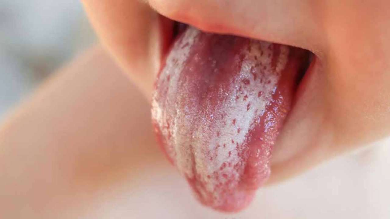 Nấm miệng Candida là bệnh gì?