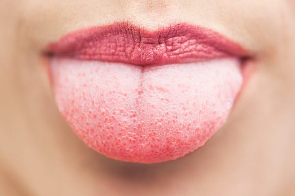 Nấm miệng candida là gì? Nguyên nhân và cách điều tr