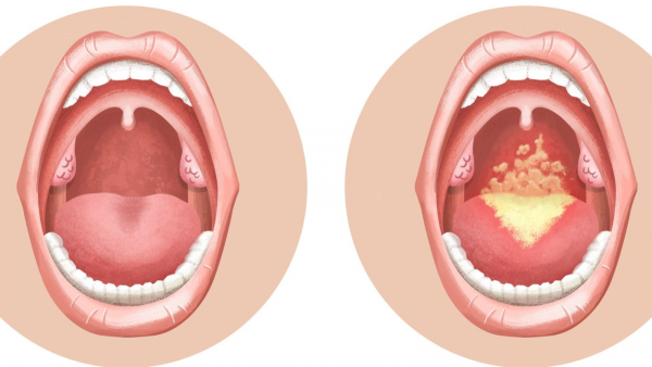 Nấm miệng candida là gì? Nguyên nhân và cách điều tr